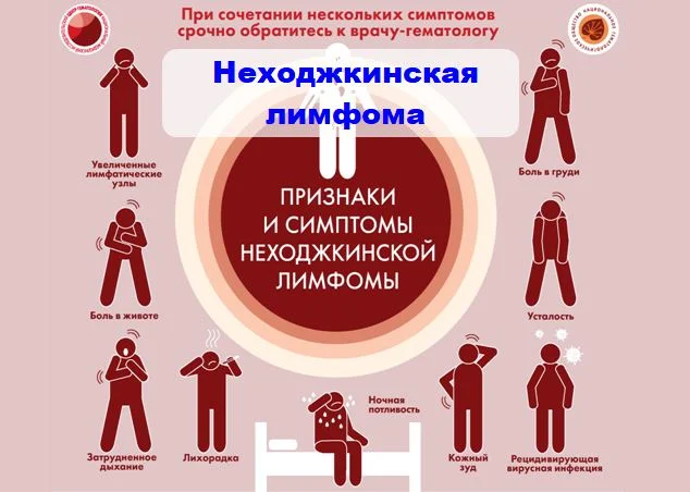 Неходжкинская лимфома. Признаки и симптомы