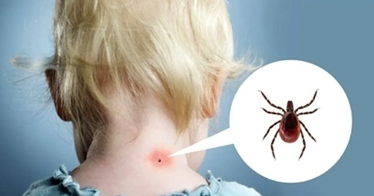 Что делать, если вас укусил клещ?